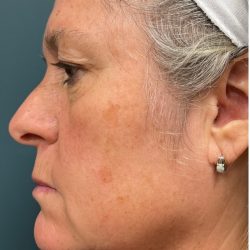 Morpheus8 Before & After Patient #2808