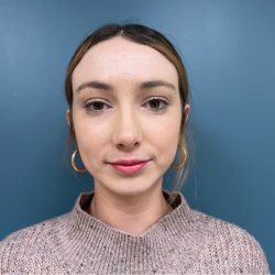 Rhinoplasty Before & After Patient #2641