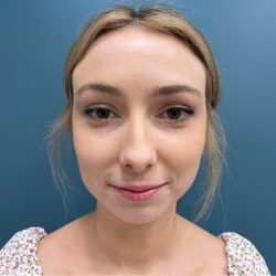 Rhinoplasty Before & After Patient #2641