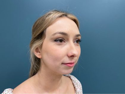 Rhinoplasty Before & After Patient #2641