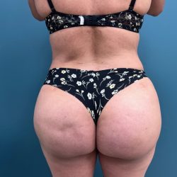 Brazilian Butt Lift Before & After Patient #2864