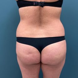 Brazilian Butt Lift Before & After Patient #2864