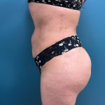 Brazilian Butt Lift Before & After Patient #2864