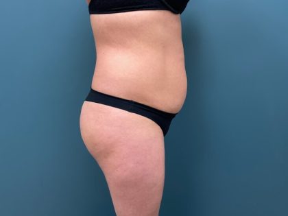Brazilian Butt Lift Before & After Patient #2864