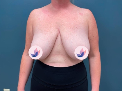 breast lift slider