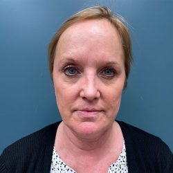 Facelift Before & After Patient #2945