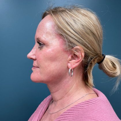 Facelift Before & After Patient #2945