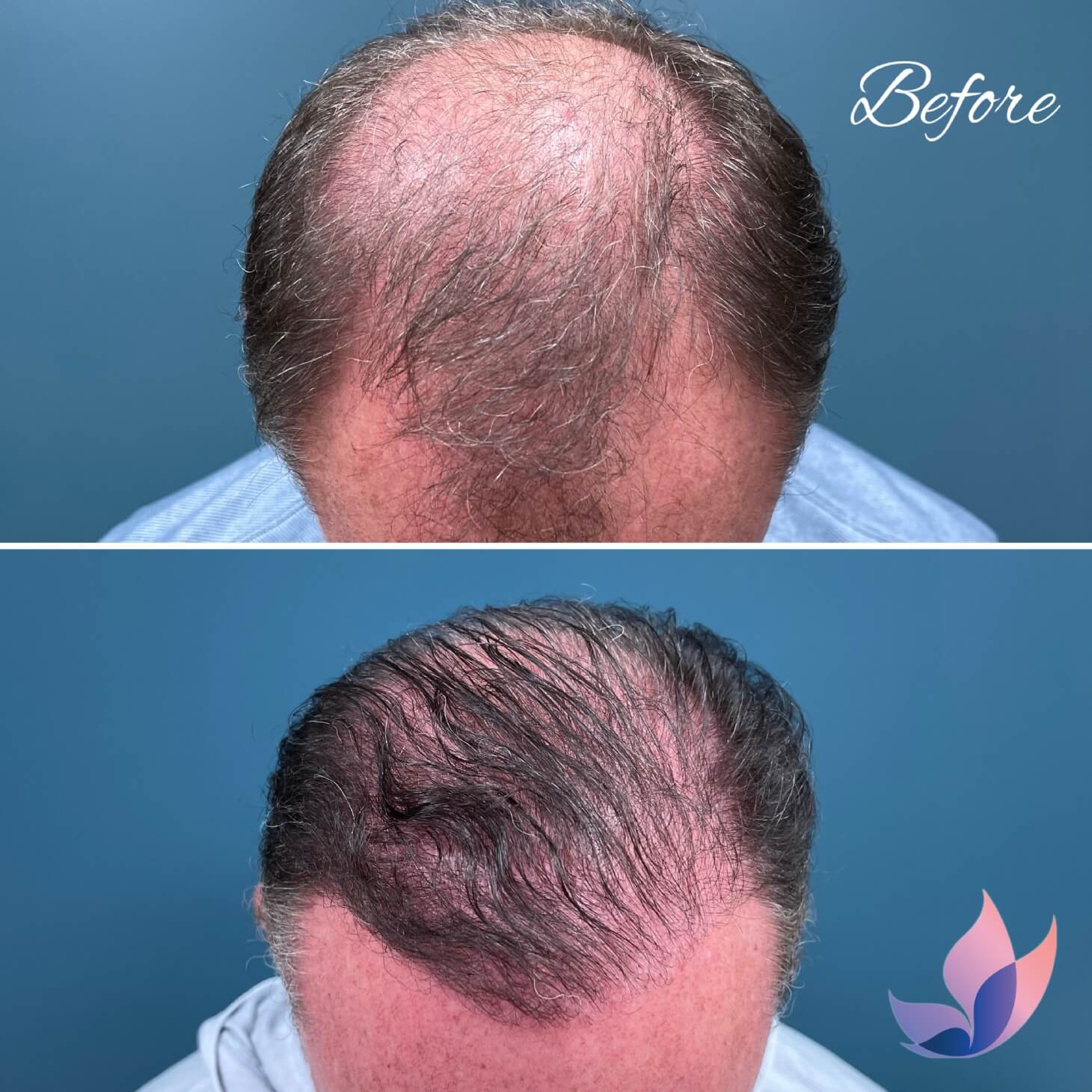 Best NeoGraft Hair Transplant Lexington, KY Plastic Surgeons of Lexington