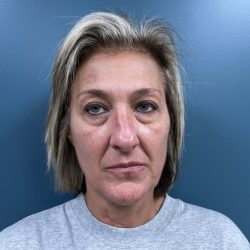 Blepharoplasty Before & After Patient #2930