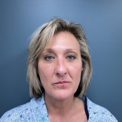 Blepharoplasty Before & After Patient #2930
