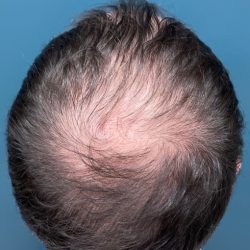 NeoGraft Before & After Patient #3045