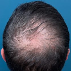 NeoGraft Before & After Patient #3045