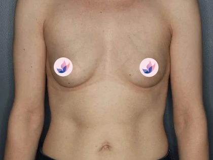 breast reconstruction slider