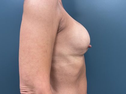 Breast Revision Before & After Patient #3017