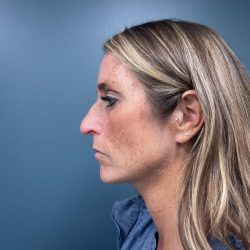 Rhinoplasty Before & After Patient #3018