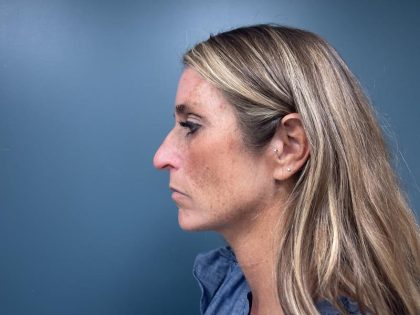 Rhinoplasty Before & After Patient #3018
