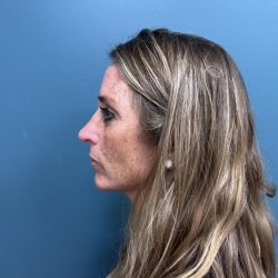Rhinoplasty Before & After Patient #3018