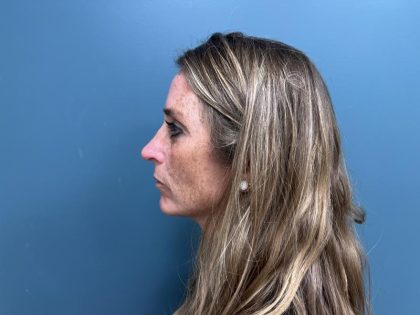 Rhinoplasty Before & After Patient #3018