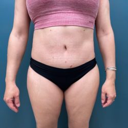 Tummy Tuck Before & After Patient #3036