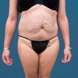 Tummy Tuck Before & After Patient #3036