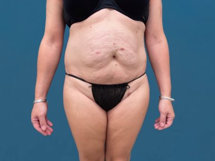 Tummy Tuck Before & After Patient #3036