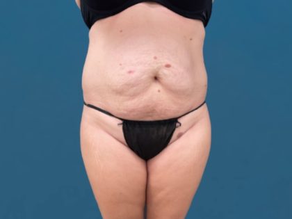 Tummy Tuck Before & After Patient #3036
