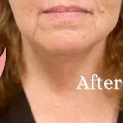 Corner Mouth Lift Before & After Patient #3075