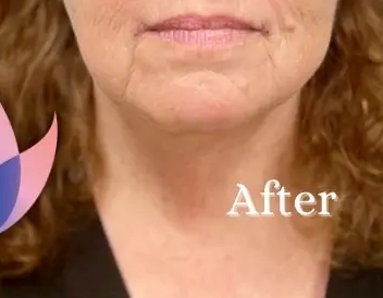 Corner Mouth Lift Before & After Patient #3075