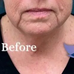 Corner Mouth Lift Before & After Patient #3075