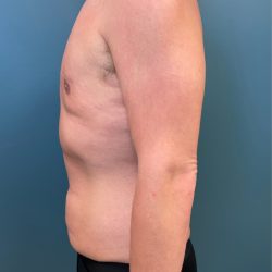 Gynecomastia Before & After Patient #3057