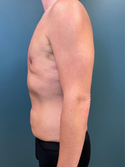 Gynecomastia Before & After Patient #3057