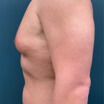 Gynecomastia Before & After Patient #3057