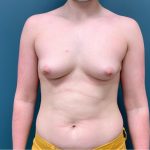 Breast Augmentation Before & After Patient #3130