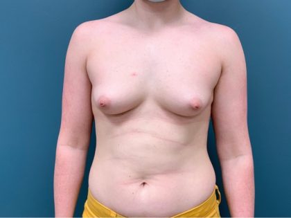 Breast Augmentation Before & After Patient #3130