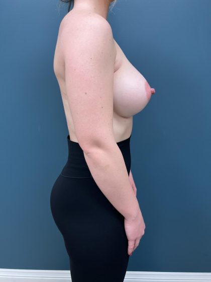 Breast Augmentation Before & After Patient #3117