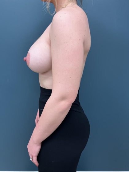 Breast Augmentation Before & After Patient #3117