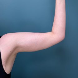 Arm Lift Before & After Patient #3150