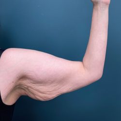 Arm Lift Before & After Patient #3150