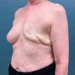 Breast Reconstruction Before & After Patient #3204