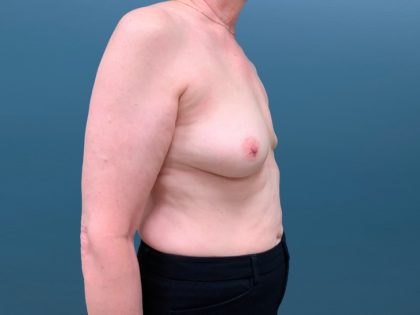 Breast Reconstruction Before & After Patient #3204