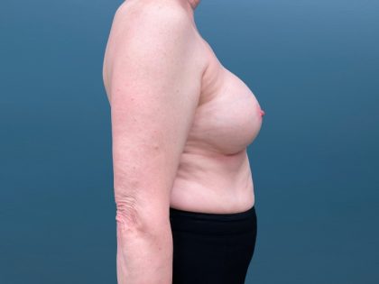 Breast Reconstruction Before & After Patient #3204