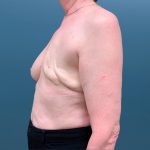 Breast Reconstruction Before & After Patient #3204