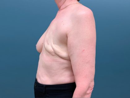 Breast Reconstruction Before & After Patient #3204