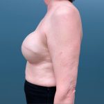 Breast Reconstruction Before & After Patient #3204