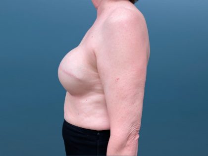 Breast Reconstruction Before & After Patient #3204