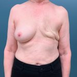 Breast Reconstruction Before & After Patient #3204