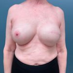 Breast Reconstruction Before & After Patient #3204