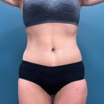 Tummy Tuck Before & After Patient #3315