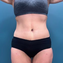 Tummy Tuck Before & After Patient #3315