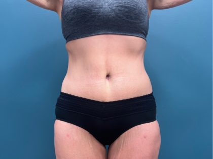 Tummy Tuck Before & After Patient #3315